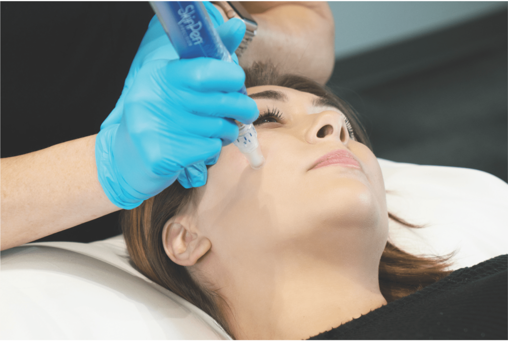 SkinPen Precision kezelés